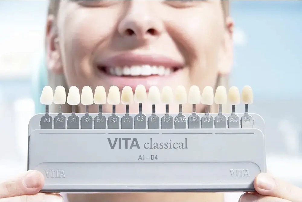 Bảng màu Vita được dùng phổ biến khi bọc răng sứ (Nguồn: ST)